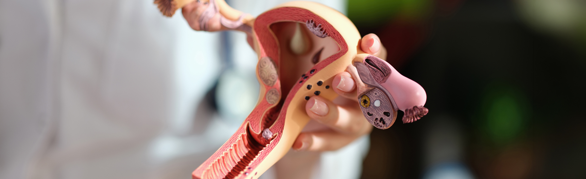 Detailed anatomical model of the uterus highlighting various uterine conditions for educational purposes.
